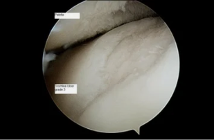 type of astroscope knee with osteoarthritis of the 3rd degree