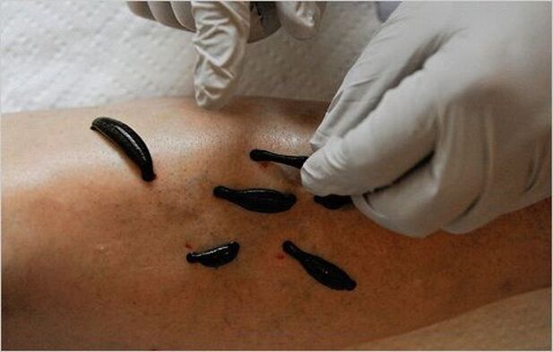 treatment of knee osteoarthritis with caterpillars