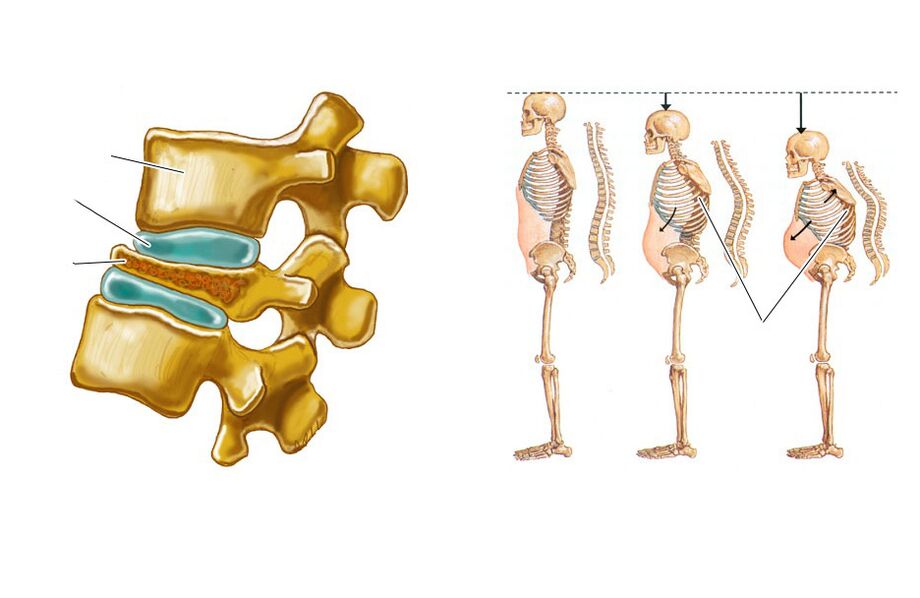 a drooping spine leads to back pain