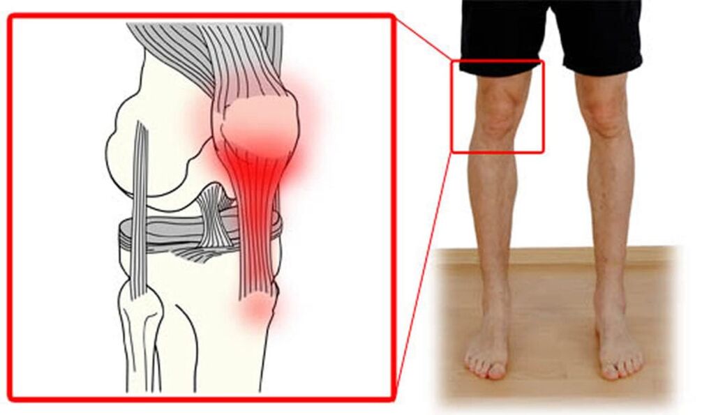 Tendinitis - inflammation of the tendons in the knee joint