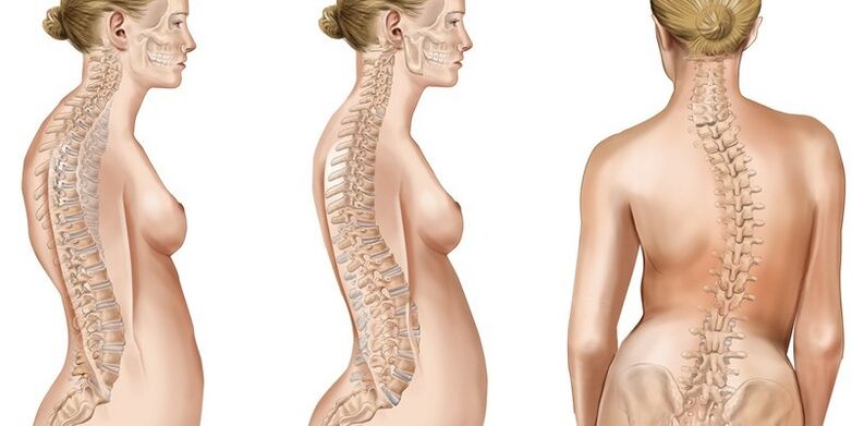 Thoracic spine scoliosis provokes the appearance of pain in the shoulder blades