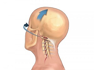 how osteochondrosis of the cervical spine manifests