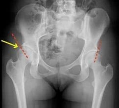 methods of treating osteoarthritis of the hip joint