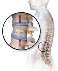 Osteoporosis provokes back pain in the lumbar region