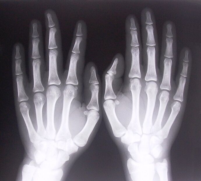 X-rays as a way to diagnose pain in the finger joints